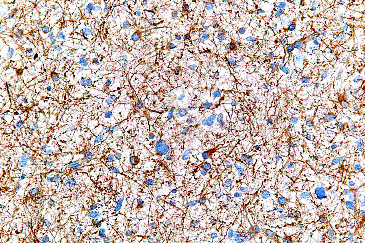 gliomma cancer from cell phone radiation